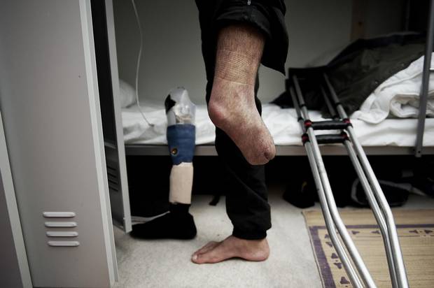 Osama Omran’s left leg had to be amputated after he was injured in a government bombing.