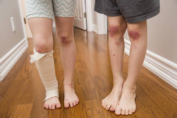 Malia Graf, left, and her brother, Maxwell, have bandages and wounds on their legs caused by 'butterfly disease'. There is no cure for epidermolysis bullosa (EB) and no effective treatment for the condition known to cause extreme pain.