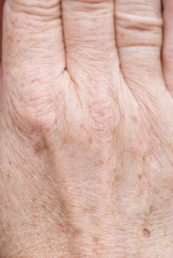 Skin Spots That Appear With Age Don T Have To Be A Permanent Fixture The Globe And Mail
