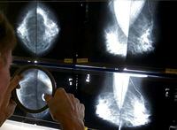 A radiologist uses a magnifying glass to check mammograms for breast cancer in Los Angeles, May 6, 2010. THE CANADIAN PRESS/AP-Damian Dovarganes