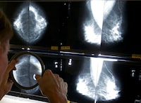 A radiologist uses a magnifying glass to check mammograms for breast cancer in Los Angeles, May 6, 2010.&nbsp;The Ontario Medical Association says about 400,000 fewer mammograms to screen for breast cancer were performed in the province during the pandemic than forecasted.&nbsp;THE CANADIAN PRESS/AP-Damian Dovarganes