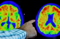 A doctor points out evidence of Alzheimer's disease on PET scans at the Center for Alzheimer Research and Treatment (CART) at Brigham And Women's Hospital in Boston, Massachusetts, U.S., March 30, 2023.     REUTERS/Brian Snyder/File photo