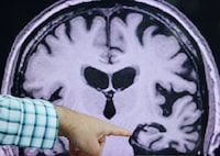 FILE PHOTO: Dr. Seth Gale points out evidence of Alzheimer’s disease on an MRI at the Center for Alzheimer Research and Treatment (CART) at Brigham And Women’s Hospital in Boston, Massachusetts, U.S., March 30, 2023.  REUTERS/Brian Snyder/File Photo